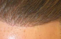 Artificial hair implant Exoderm Medical Centers