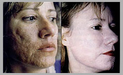exoderm peel acne scars